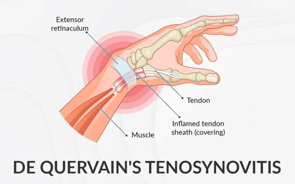 De Quervains Tenosynovitis Overview Physical Therapy Treatment And Exercise