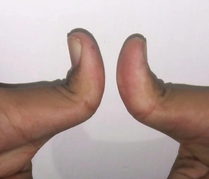 Hitchhiker Thumb Deformity: